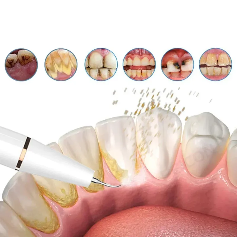 Ultrasonic Dental Plaque Remover Professional Grade Tartar Cleaning Tool - Product showcase